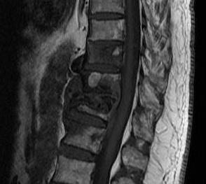 Thoracic Metastasis